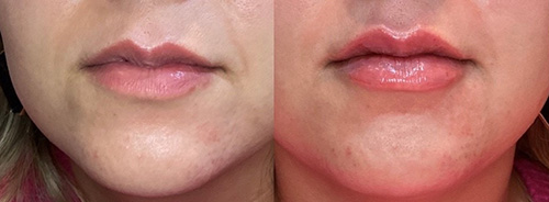 Dermal Filler Ashland KY - Before & After Lower Face and Lip Treatment